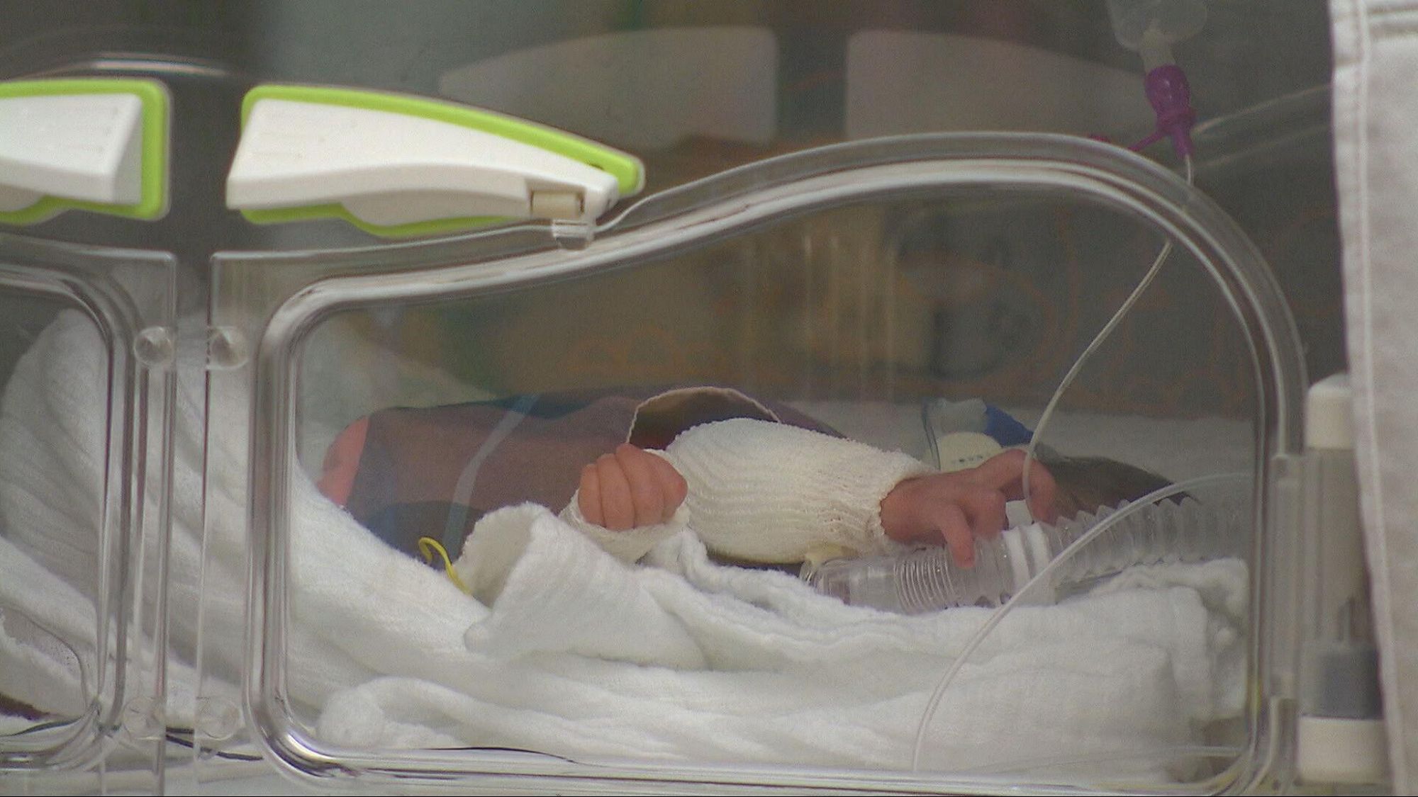 Buone notizie dall’ospedale Mondali, la piccola Teresa si è svegliata: «Piange e si muove»