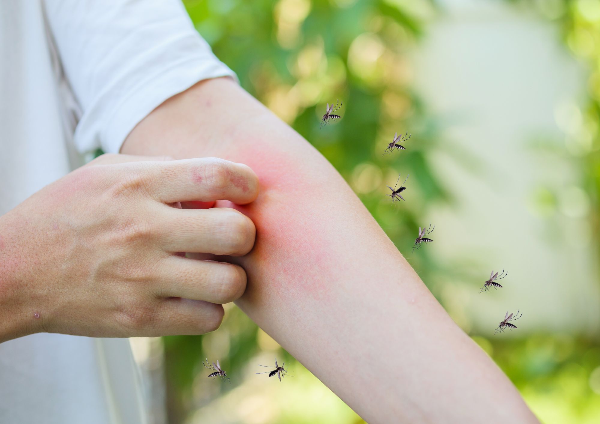 Zanzare, come affrontare le punture: dai rimedi naturali ai piccoli accorgimenti per ridurre il fastidio